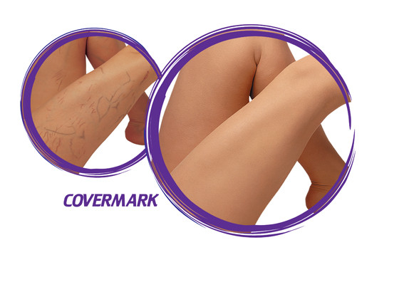 DoubleTakeCover cosmetics Pic 2 - Revolutionary concealment in practice Varicoseveins Spiderveins Stretch marks TatooCover or Vilitigo