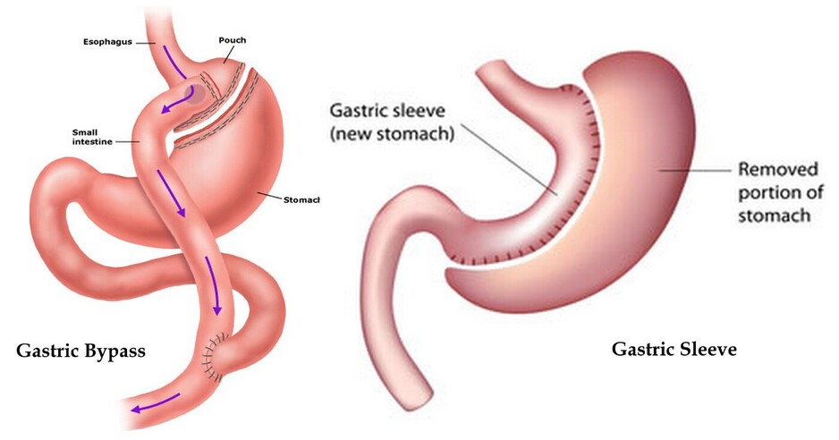 Gastric Sleeve Melbourne - Complete Weight Loss Solution Pic 1