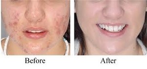 Skin Sensational Pic 3 - Before and After Acne treatment