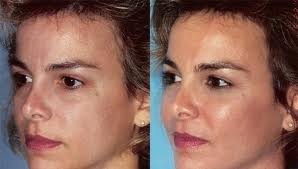 Skin Sensational Pic 5 - Before and After cheek filler