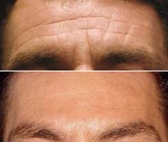 Skin Sensational Pic 1 - before and after forehead botox