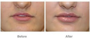 Skin Sensational Pic 2 - Before and After Lip Filler