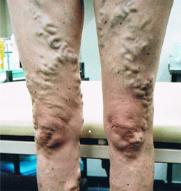 The Leg Vein Clinic Pic 3 - Do not get surgery for your varicose veins Nonsurgical treatment for variose veins at The LVC