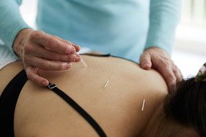 The Wellbeing Sphere Pic 2 - Chakrapuncture use very fine needles which lay down on the body