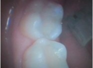 InternationalSmiles Pic 3 - Case 9 AFTER Old fillings drilled out and replaced with tooth coloured composite