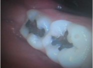 InternationalSmiles Pic 2 - Case 9 BEFORE Old fillings drilled out and replaced with tooth coloured composite