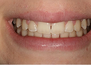 McCloy Dental Pic 3 - After McCloy Dental Treatments