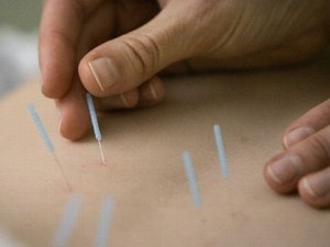 Dr Chris Eddy Acupuncture and Chinese Medicine Pic 5 - Gentle insertion effective acupuncture