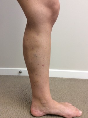 Sunshine Vein Clinic Pic 3 - After treatment by Dr Hugo PIN