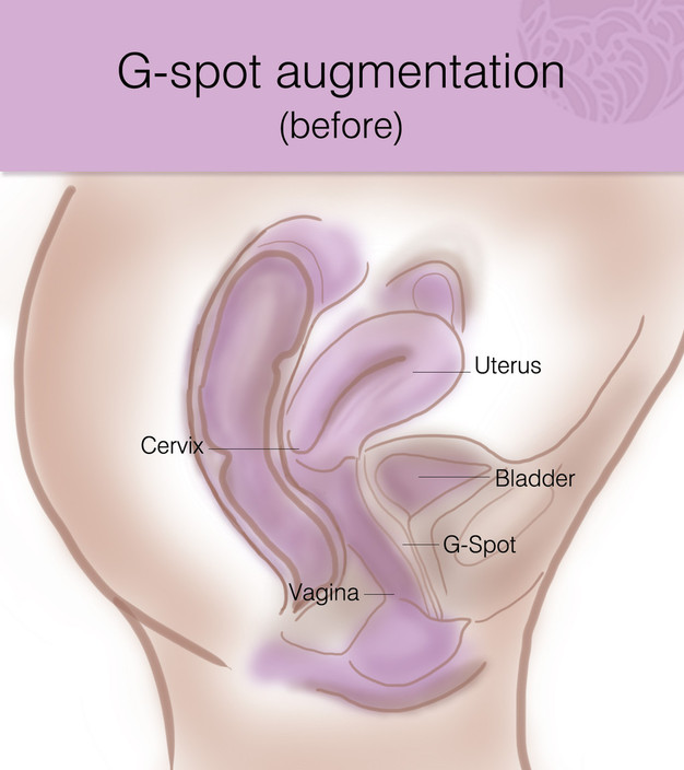 Labiaplasty at Perth Pic 1