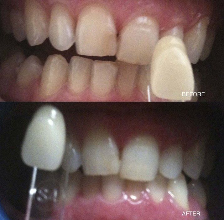 Teeth Whitening bu Vanessa Pic 1