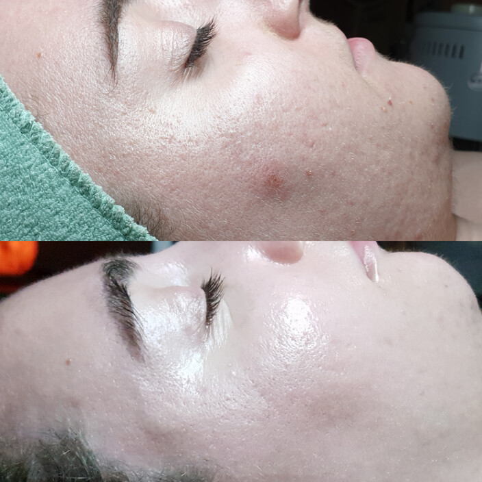 Living Skin Clinic Pic 1 - Results based Skin Treatments using Dermaviduals for issues like Acne Pigmentation Dehydration Rosacea Sun Damage Wrinkles more