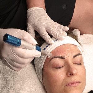 Living Skin Clinic Pic 2 - CIT Skin Needling for Skin Correction Antiageing and Rejuvenation CIT Treatment Packages available