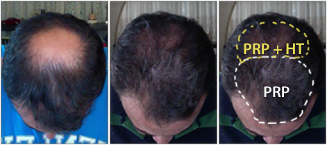 PRP for Hair Loss Pic 1