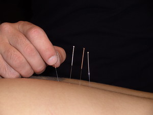 Performance Myotherapy Pic 2 - Myofascial Dry Needling