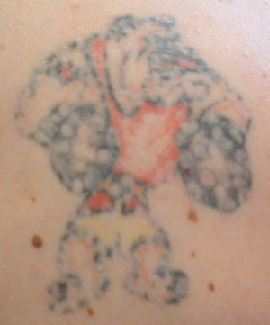 Tattoo Removal Erina Fair Pic 3 - 12 weeks after 1st treatment