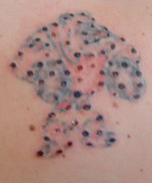 Tattoo Removal Erina Fair Pic 2 - After 1st treatment