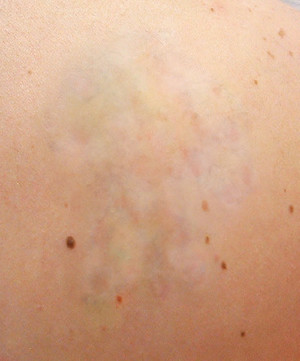 Tattoo Removal Erina Fair Pic 4 - At 12 months after 5 treatments