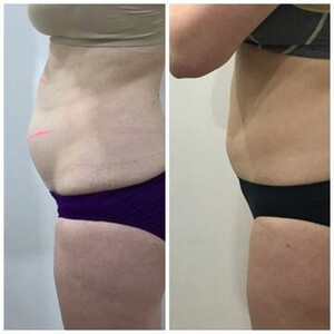 Phenotype Skin Body Pic 3 - Fat Freezing to remove stubborn areas of fat with no surgery and 40 minute treatment with no down time