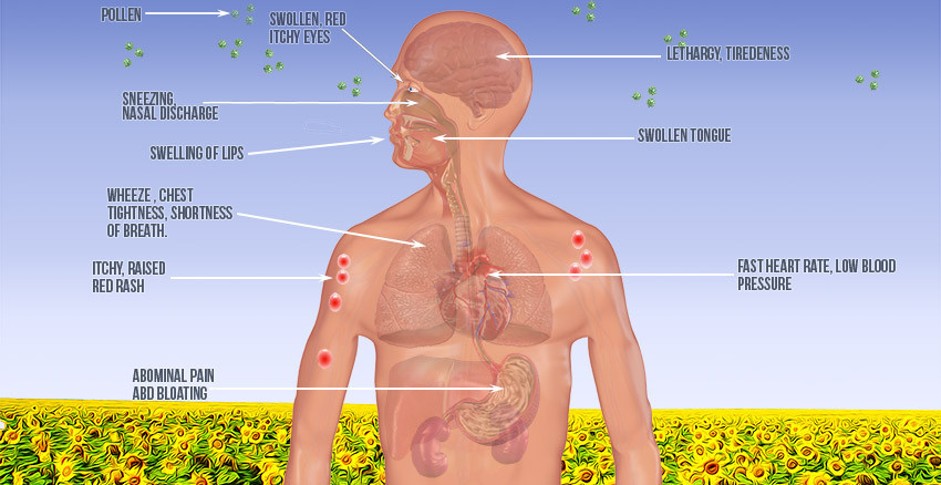 Airway Allergy Clinic Pic 1 - This digram shows all the regions of the body affected by allergies