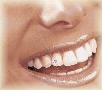 Stunnerz Teeth Whitening Pic 1